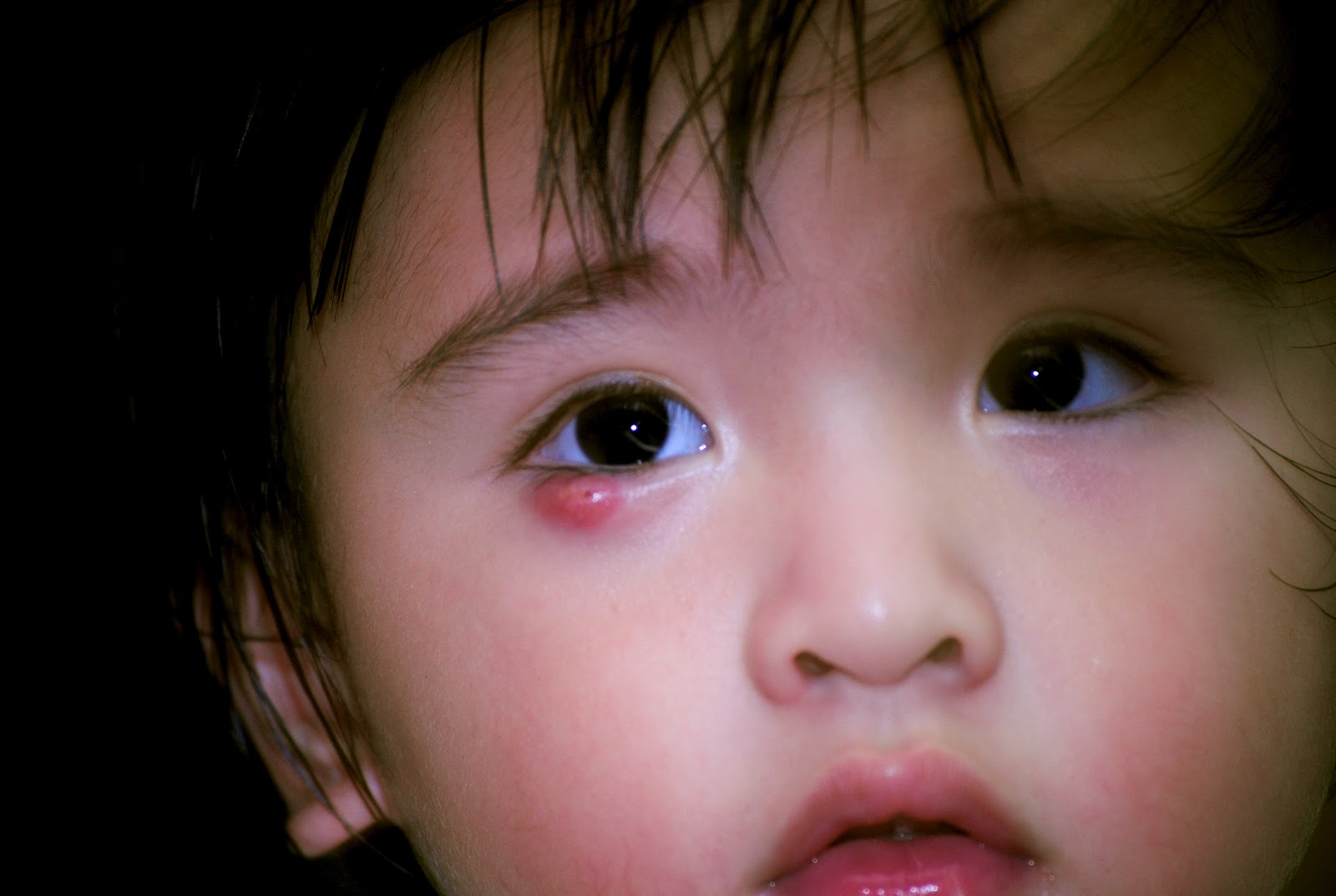 Eye Infection Types Symptoms Treatments In Babies New Kids Center