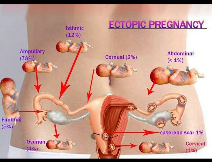 Human Biology Online Lab Ectopic Pregnancy