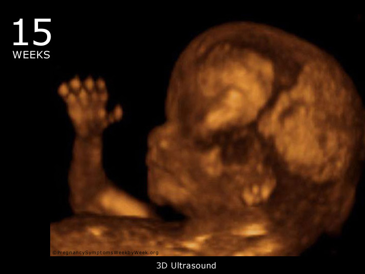 photo of 20 week old fetus